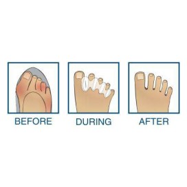 Correctores de dedos -Correct Toes-