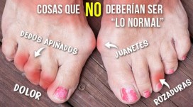 Tu pie se deforma por el calzado