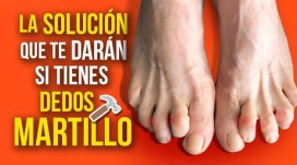 Die Lösung, die sie Ihnen geben, wenn Sie Hammerzehen haben