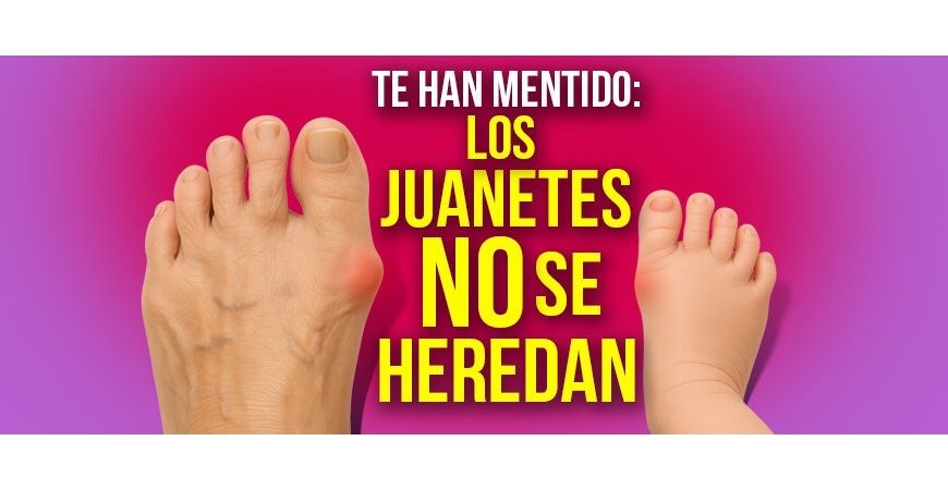 A mentira dos joanetes herdados