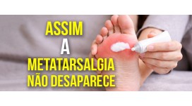 Nem pomadas nem palmilhas resolvem o problema da metatarsalgia