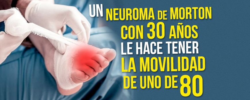 Un Neuroma de Morton con 30 años le hace tener la movilidad de uno de 80